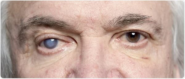 مقابله با نابینایی ناشی از دیابت با سلول های بنیادی پرورش یافته در آزمایشگاه