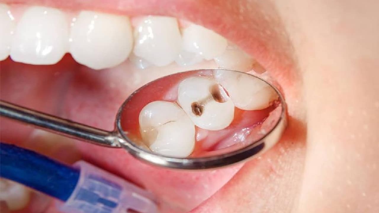 چرا دندان هایم زود به زود پوسیده می شوند؟