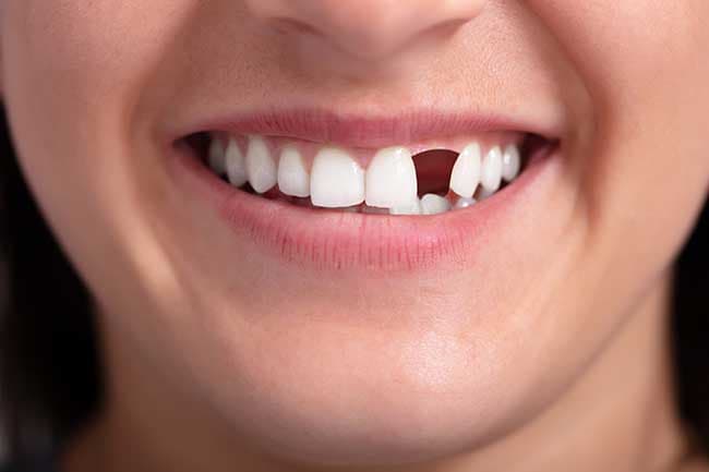 چگونه ایمپلنت کیفیت غذا خوردن و صحبت کردن را متحول می‌کند؟