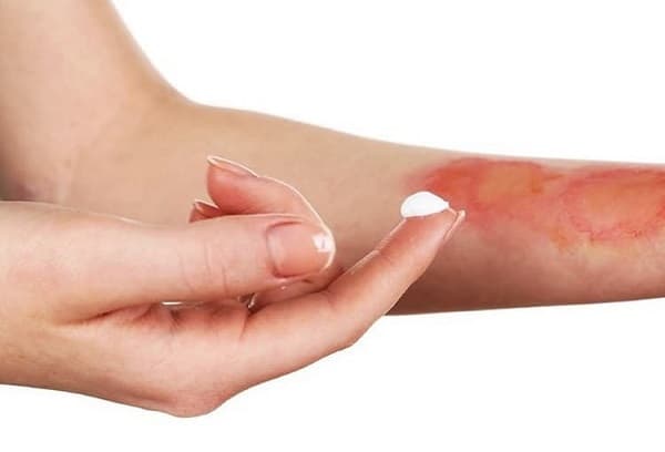اقدامات صحیح هنگام سوختگی/ اینفوگرافیک