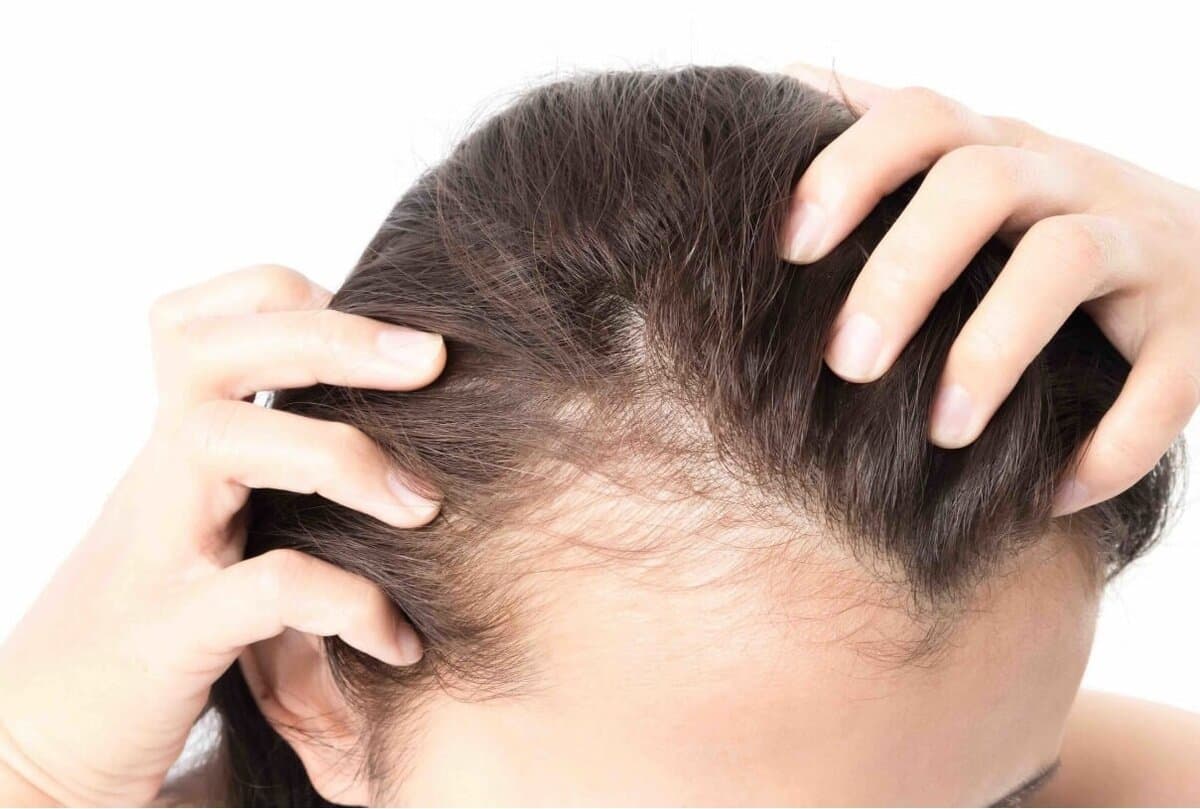 مطالعه جدید درباره رابطه پوشش‌های سر و ریزش موی کششی
