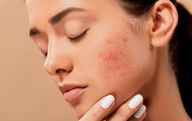 افزایش هشدار متخصصان درباره آسیب پوستی ناشی از ترندهای زیبایی شبکه‌های اجتماعی