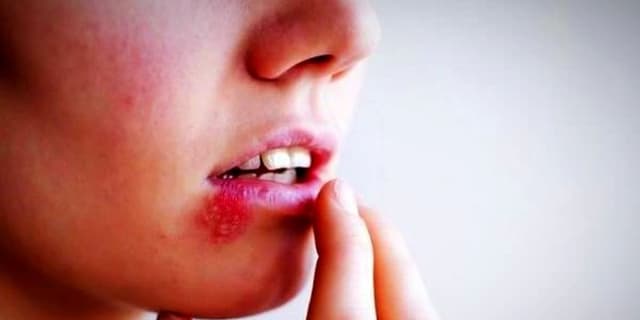 چگونه تب خال را درمان کنیم؟