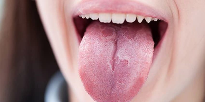 دلیل ترک روی زبان و پارگی زبان در طب سنتی