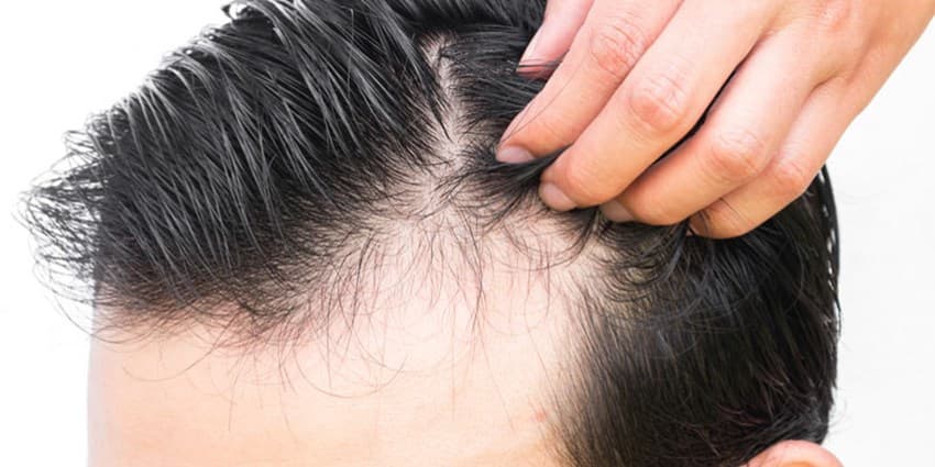 چند راهکار برای جلوگیری از ریزش مو