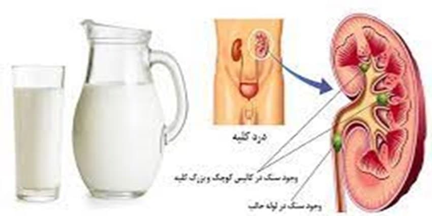 ارتباط نوشیدن شیر با خطر ابتلا به سنگ کلیه