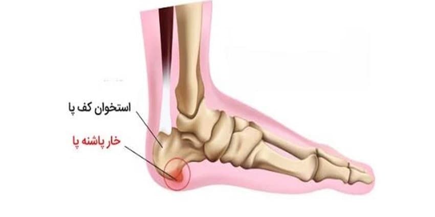 درد پاشنه پا را جدی بگیرید