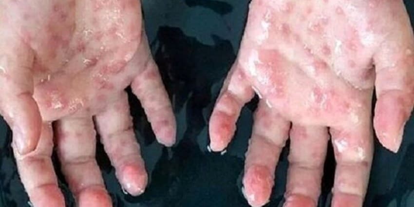 افزایش موارد ابتلا به آبله میمون در آفریقای جنوبی
