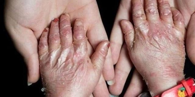آمریکا در پرونده "تحریم کودکان پروانه‌ای" محکوم شد