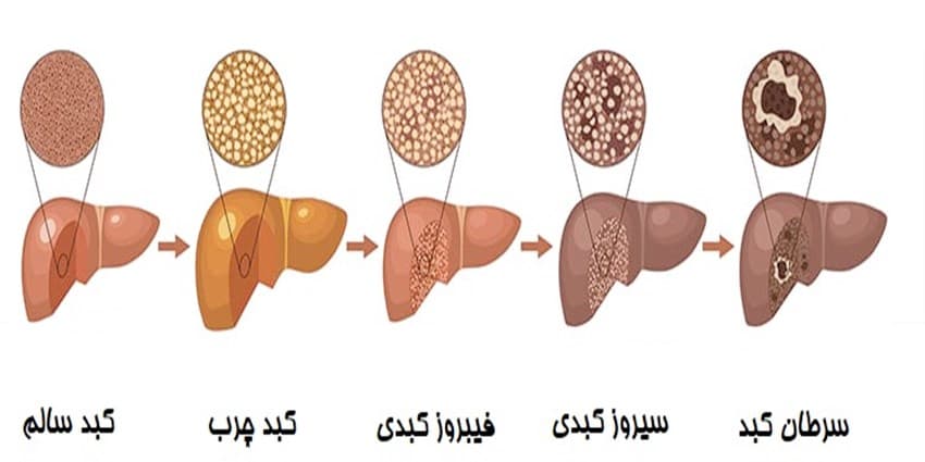 چه زمانی برای کبد چرب به پزشک مراجعه کنیم؟