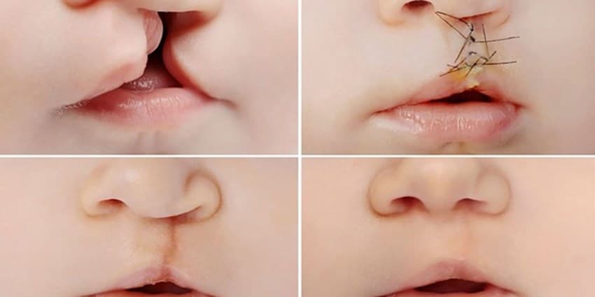 «شکاف لب» در کودک چه مشکلاتی ایجاد می‌کند؟