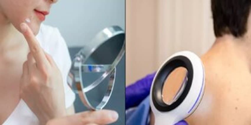 کدام جوش‌ها نشانه سرطان پوست است؟