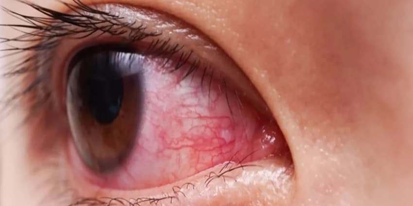 چرا چشم‌هایتان همیشه قرمزند و چه باید بکنید؟