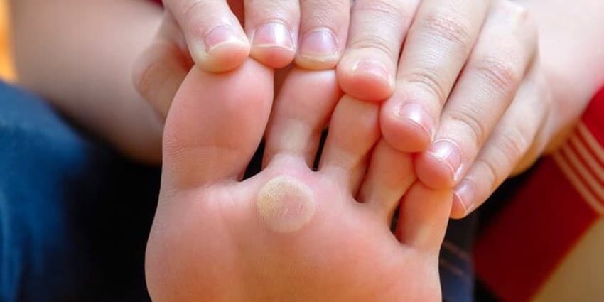 چگونه تاول پا را درمان کنیم؟
