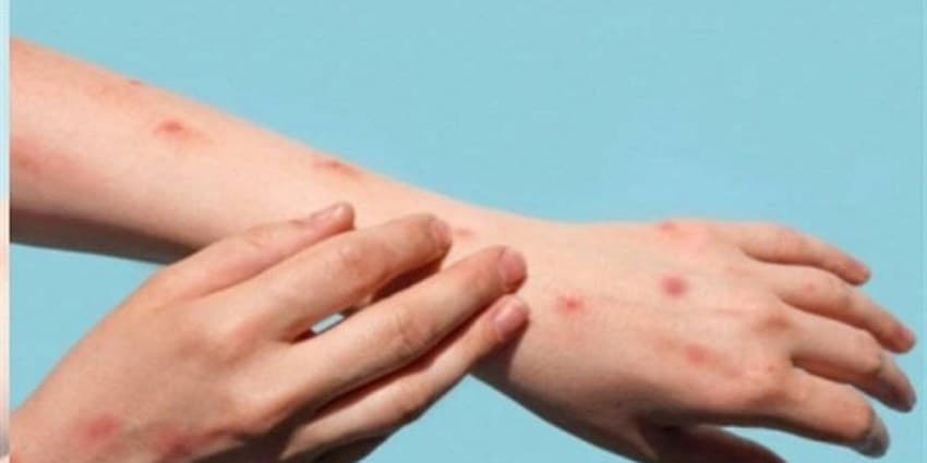 آبله میمونی چيست و چگونه منتقل مي‌شود؟
