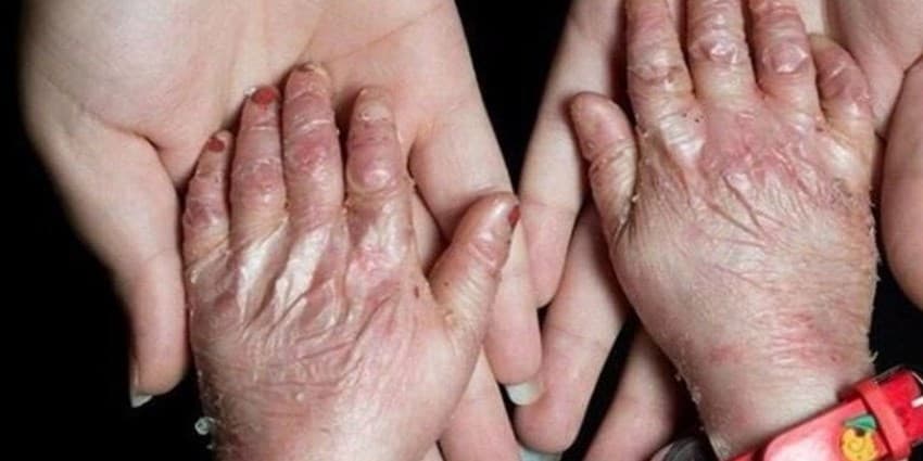 صدای «کودکان پروانه ای» باید بیشتر شنیده شود