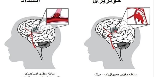 چه کسانی بیشتر در معرض خطر سکته مغزی هستند؟