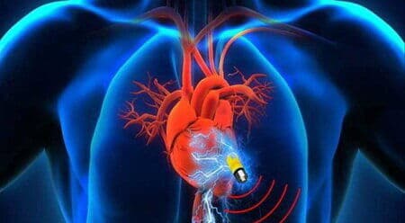 پایان صف انتظار باتریهای قلبی و ICD؛ تأمین تجهیزات برای ۱۲ هزار بیمار