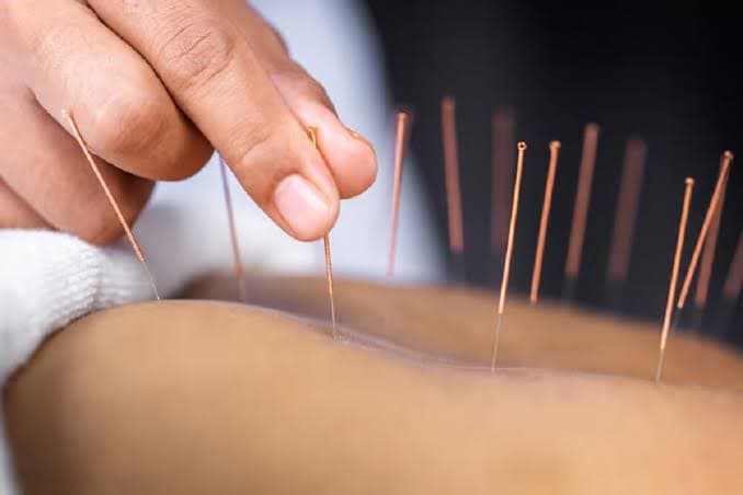 مطالعه بالینی: ترکیب طب سوزنی و داروی گیاهی با بهبود اولیه پس از سکته مغزی همراه بود