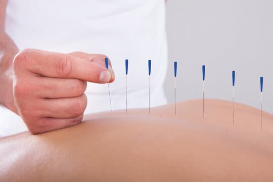 طب سوزنی برای درمان سیاتیک مفید است؟