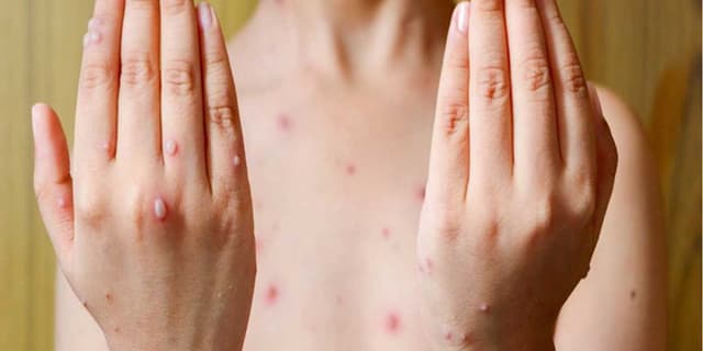 آبله میمونی همچنان وضعیت اضطراری بهداشت جهانی است