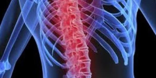 تحریک طناب نخاعی در کاهش نوروپاتی دیابتی موثر است