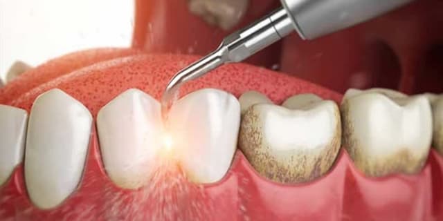 چرا باید جرم گیری دندان را جدی بگیریم؟