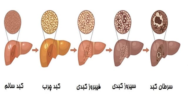 چه زمانی برای کبد چرب به پزشک مراجعه کنیم؟