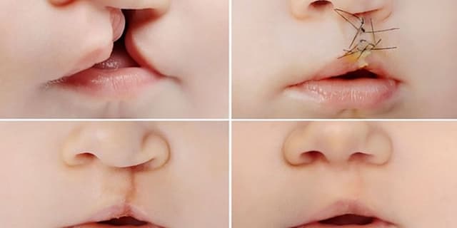 «شکاف لب» در کودک چه مشکلاتی ایجاد میکند؟
