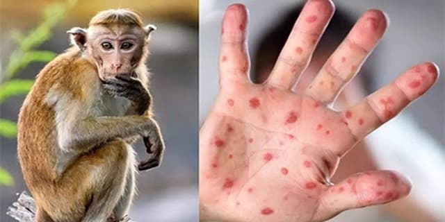 اولین مورد ابتلا به «آبله میمونی» در فیلیپین شناسايي شد