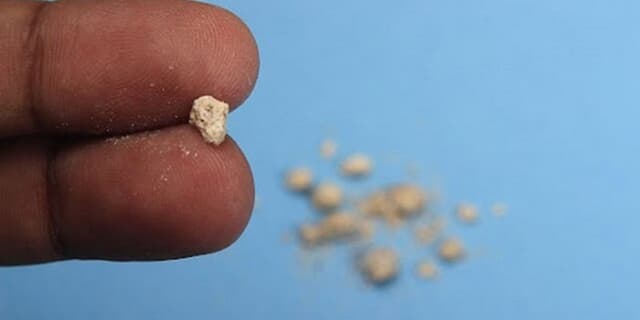 انواع سنگ کلیه و درمانهای تغذیهای آن